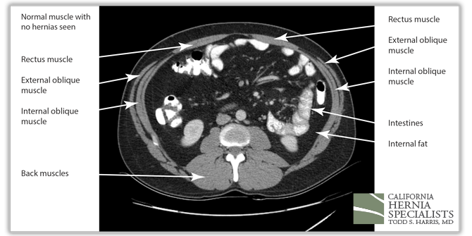Spigelian Hernia CT image